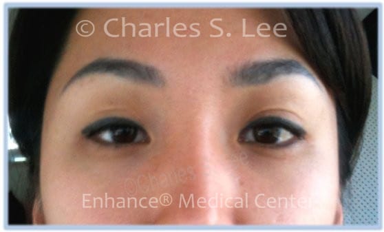 Upper Eyelid Recovery