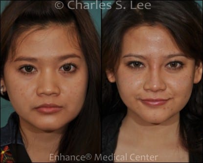 Before and After Non Surgical Nose Job