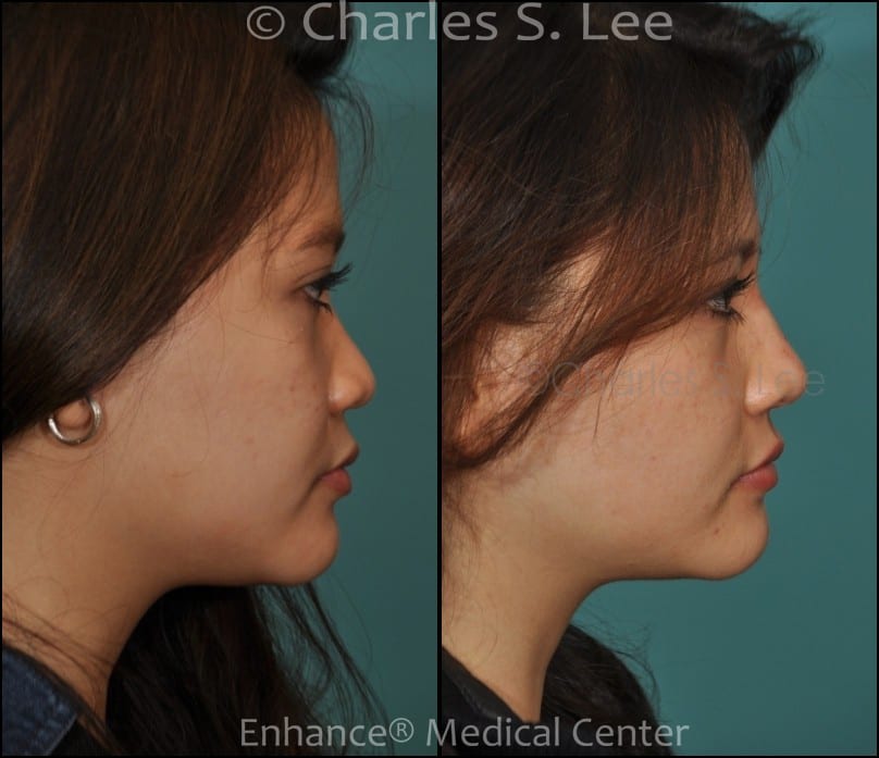 Before and After Non Surgical Nose Job Side View