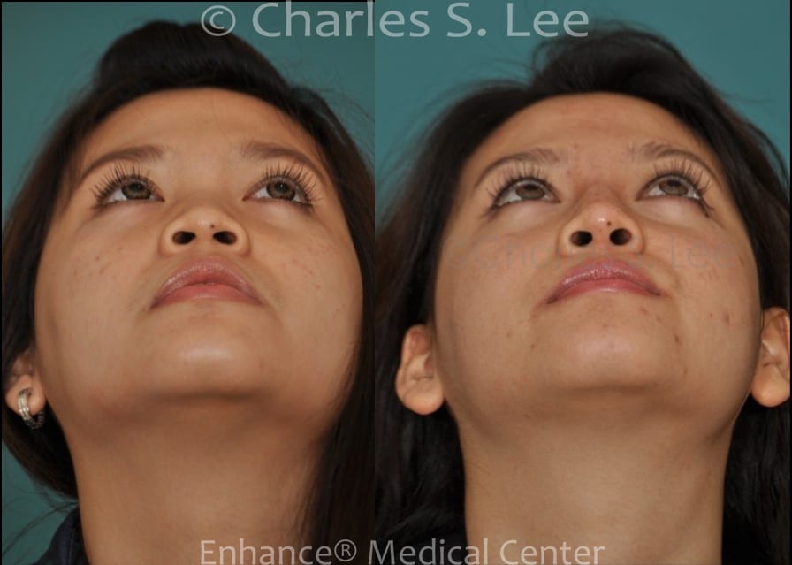 Before and After Non Surgical Nose Job Under Nose View