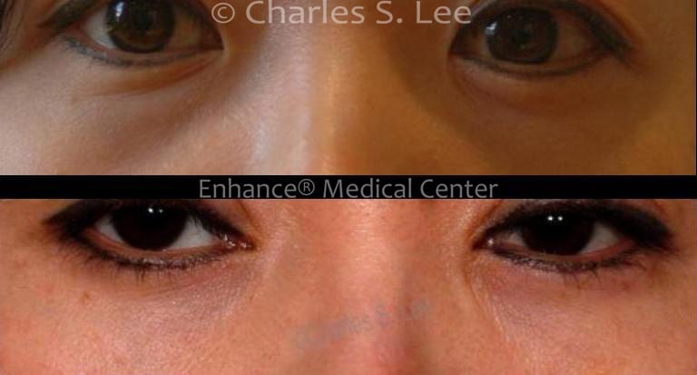 Before and After Lower Eyelid Surgery