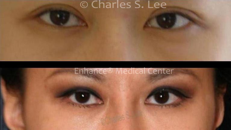 Before and After Lower Eyelid Surgery 2