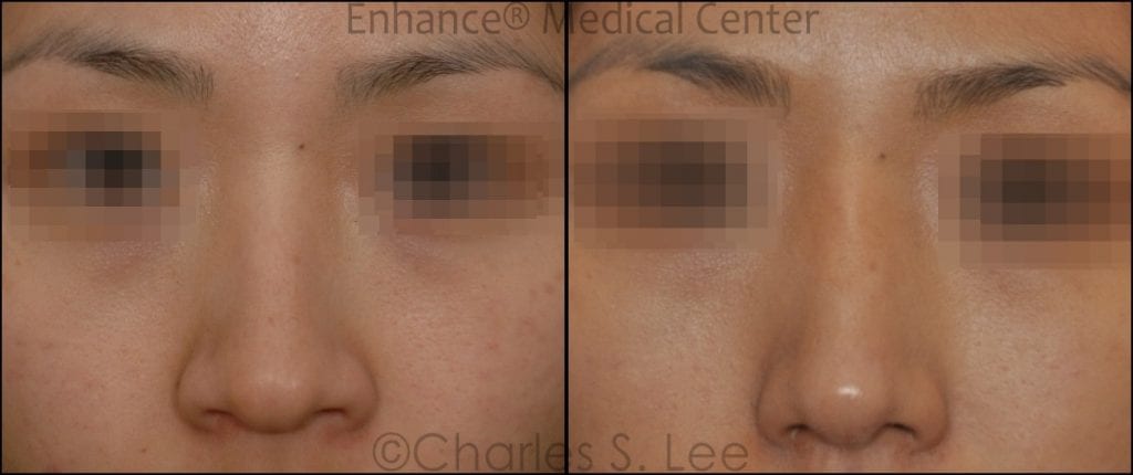 Before and After Open Rhinoplasty