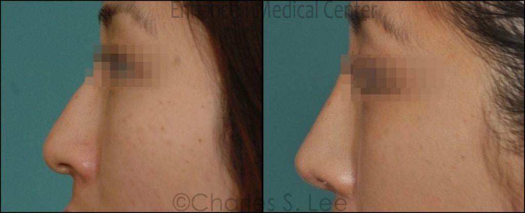 Before and After Open Rhinoplasty 2