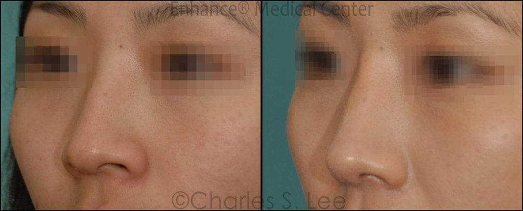 Before and After Open Rhinoplasty 3