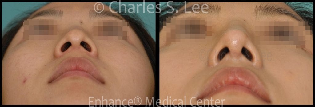 Before and After Open Rhinoplasty 4