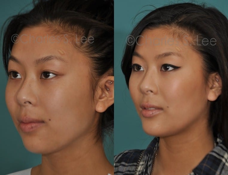 Before and After Chin Augmentation Side View