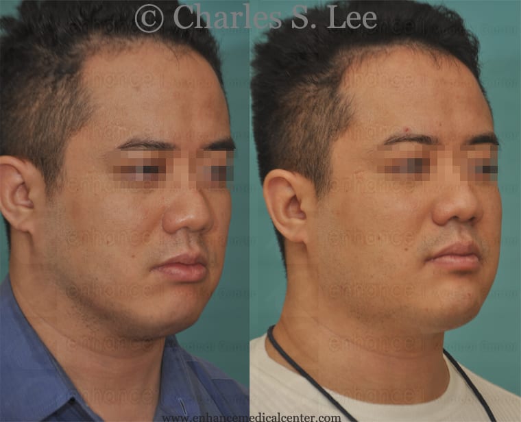 Intraoral Jaw Augmentation Oblique View