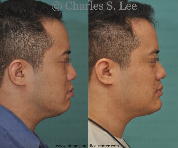 Intraoral Jaw Augmentation Side View