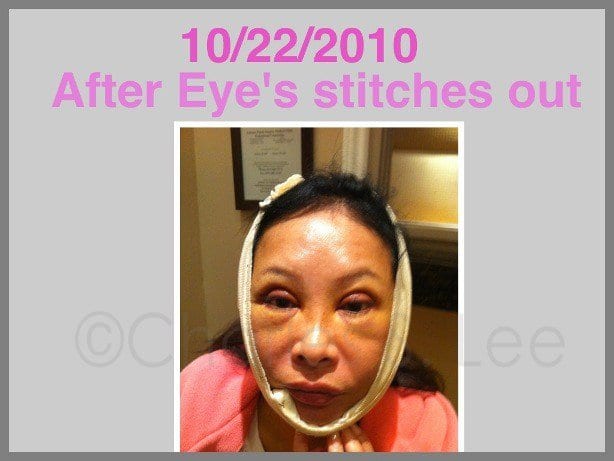 Face and Neck Lift with Upper and Lower Eyelid Surgery Actual Patient 6