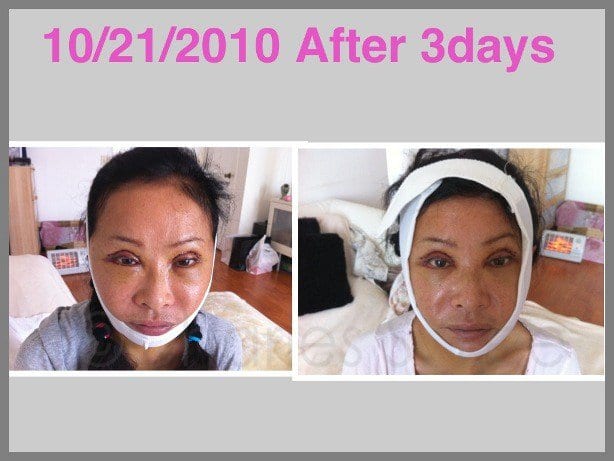 Face and Neck Lift with Upper and Lower Eyelid Surgery Actual Patient 5