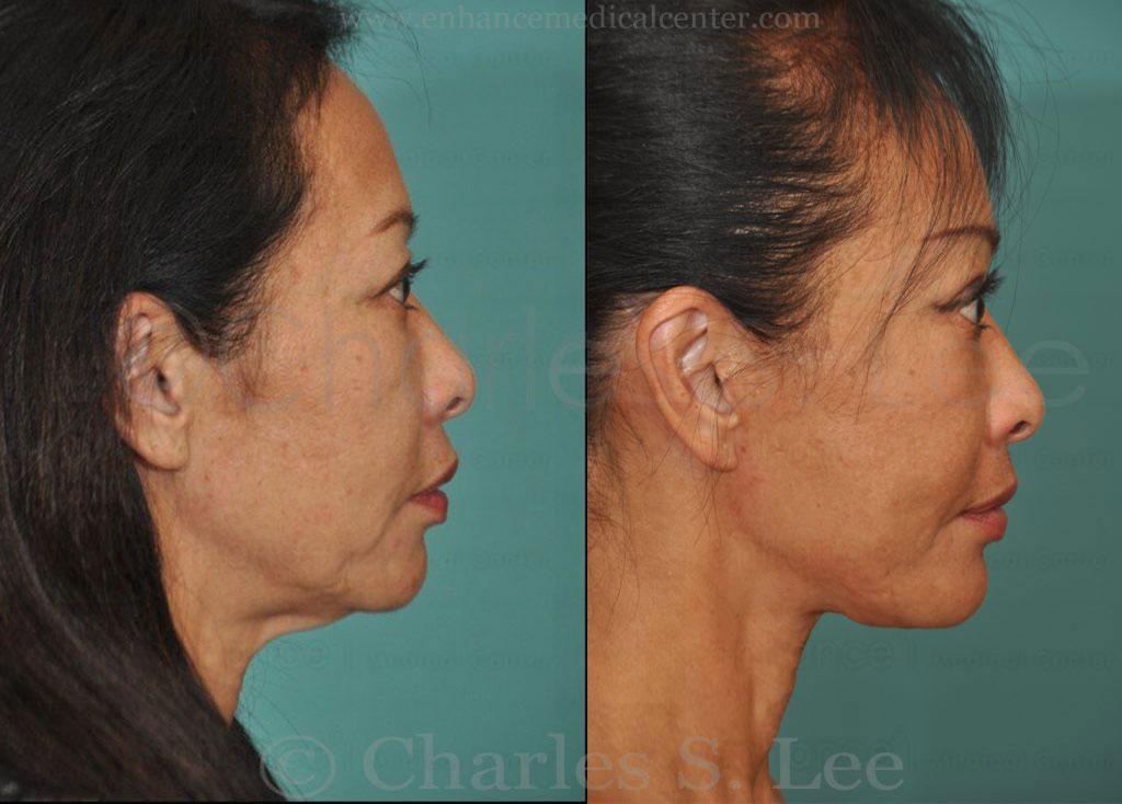 Face and Neck Lift with Upper and Lower Eyelid Surgery Actual Patient 2