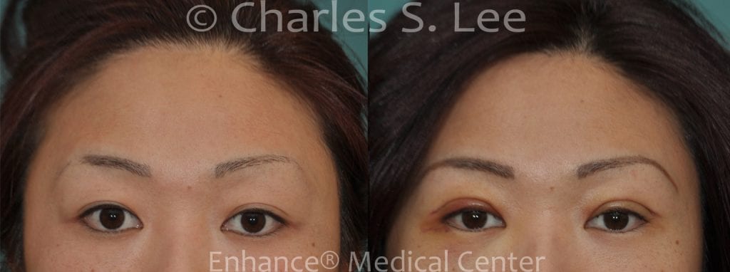 Incision Eyelid Surgery 5 days post operative