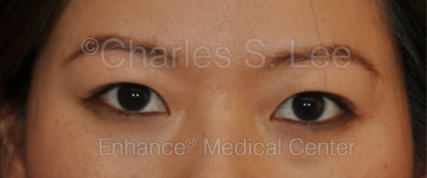 Asian Eyelid Surgery Patient Before