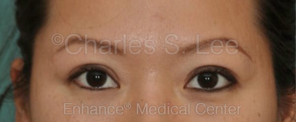 Asian Eyelid Surgery Patient After