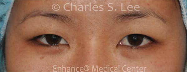 Asian Eyelid Surgery Patient Before 2