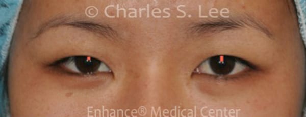 Asian Eyelid Surgery Patient After 2