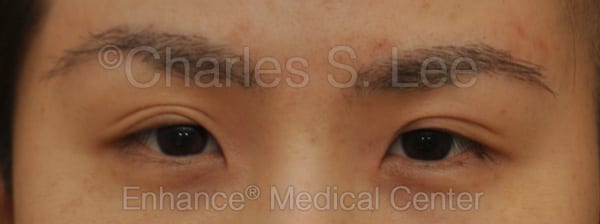 Asian Eyelid Surgery Patient Before 4