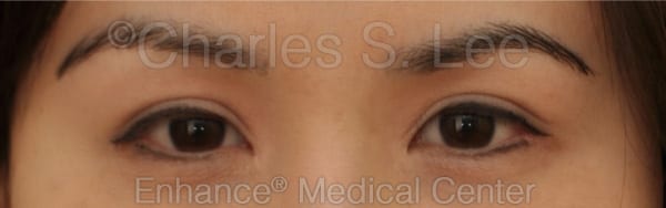 Asian Eyelid Surgery Patient Before 4