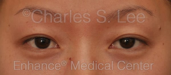 Asian Eyelid Surgery Patient Before 5