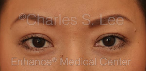 Asian Eyelid Surgery Patient After 6