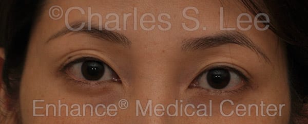 Asian Eyelid Surgery Patient Before 7