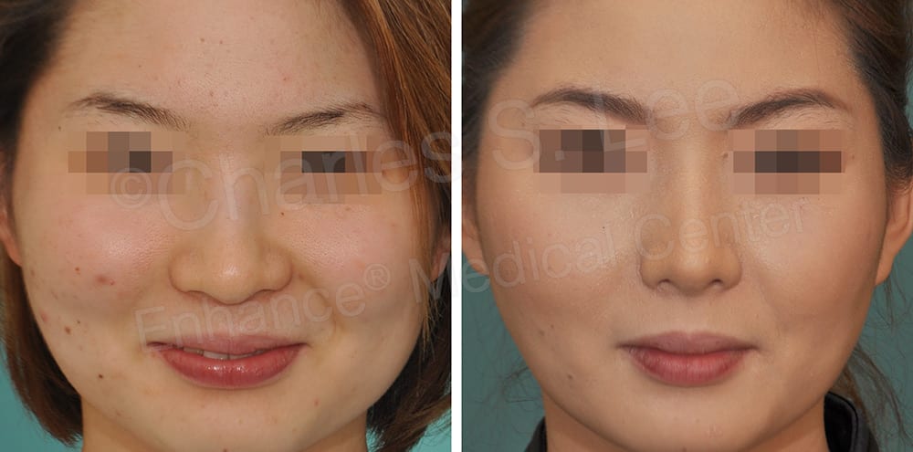 Asian Rhinoplasty Nose Surgery Genioplasty BZ