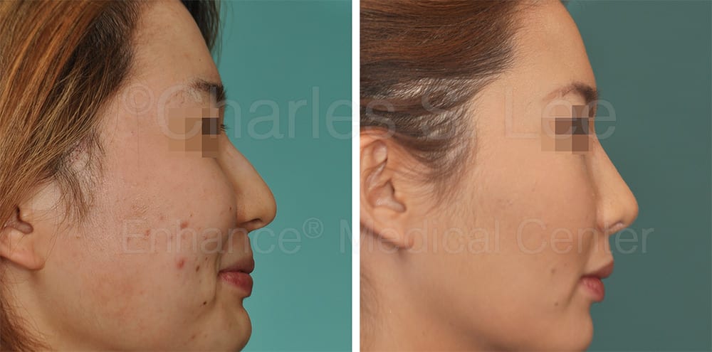 Asian Rhinoplasty Nose Surgery Genioplasty BZ