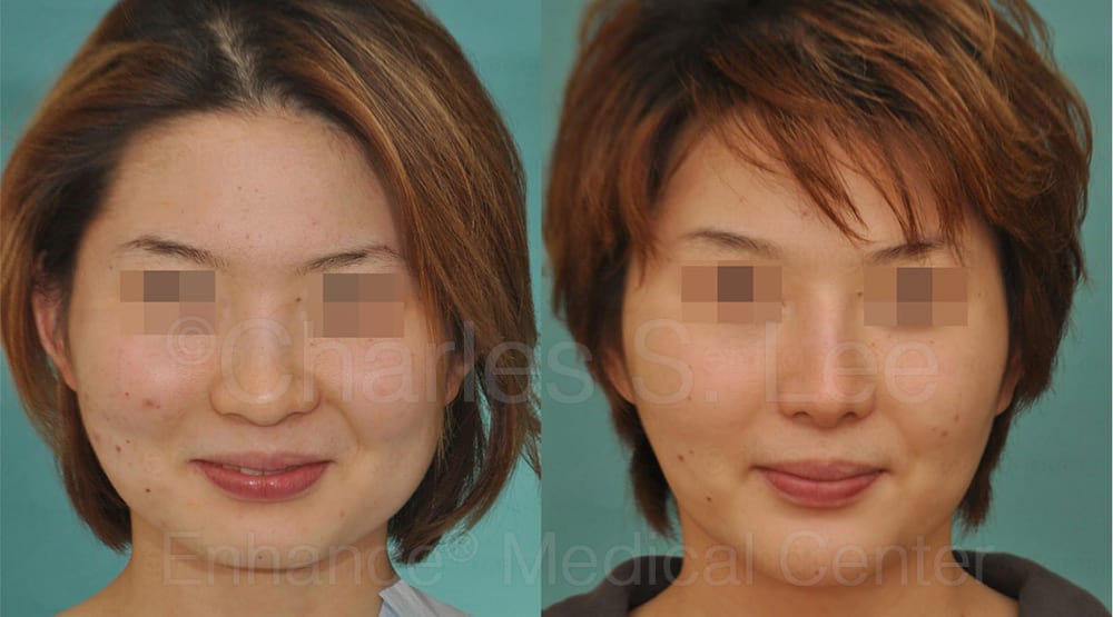 Asian Rhinoplasty Nose Surgery Genioplasty BZ