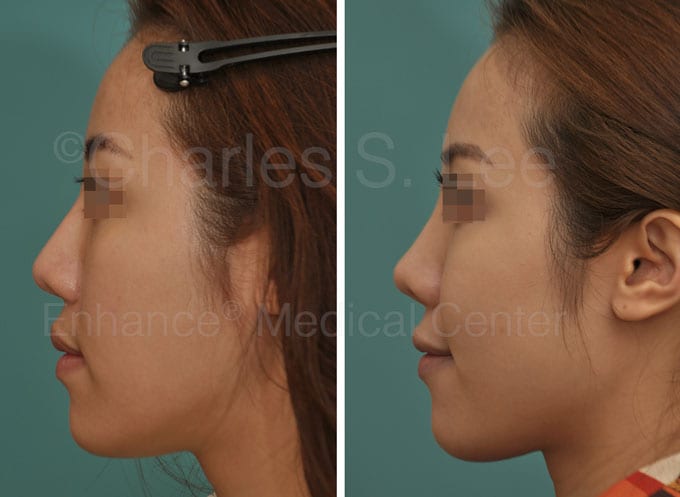 Silicone Nose Implant 15