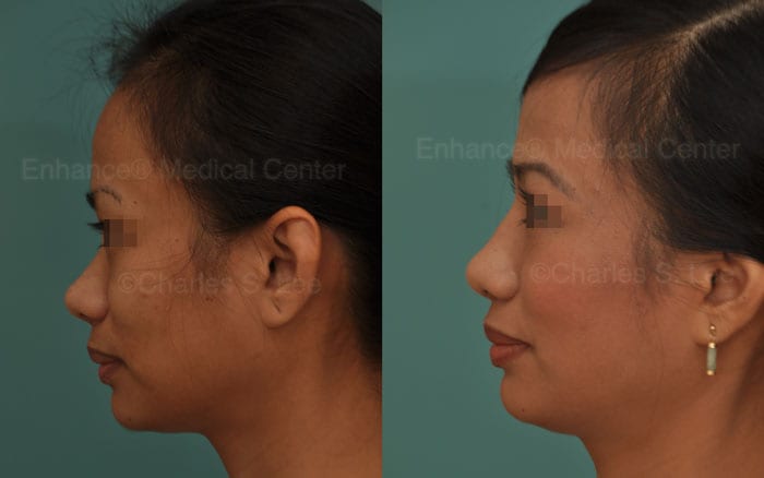 Profile view of recent Rhinoplasty using Ear Cartilage