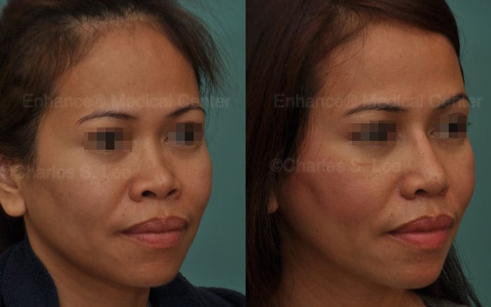 asian rhinoplasty nose surgery ear cartilage natural charles s. lee nose bridge