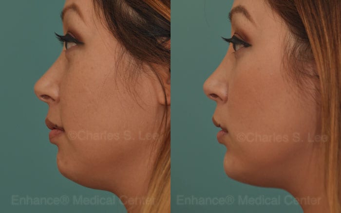 1 Week After Non-Surgical Chin Augmentation Using 1.5cc Filler