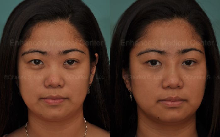 Non-Surgical Rhinoplasty Using 0.5cc Filler 1 Week After