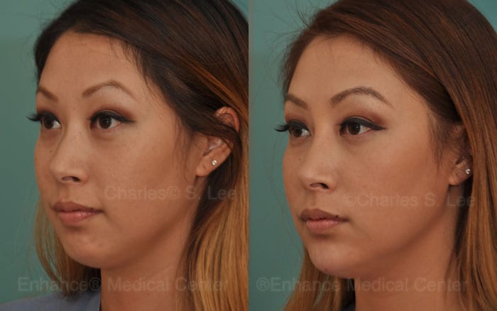 non surgical chin augmentation filler dr. charles s. lee asian