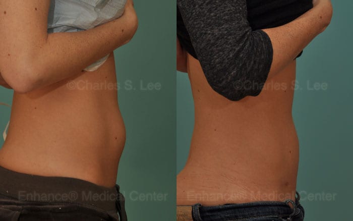 Liposuction to Lower Abdomen without using General Anesthesia by Dr. Charles S. Lee