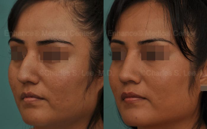 hispanic-rhinoplasty-hispanic rhinoplasty-nose job-dr charles lee-dr charles s lee-hump reduction-plastic surgery-cosmetic surgery-surgery