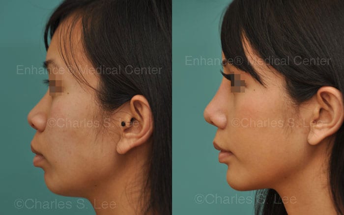 Rhinoplasty w/ Chin Augmentation by Dr. Charles S. Lee ...