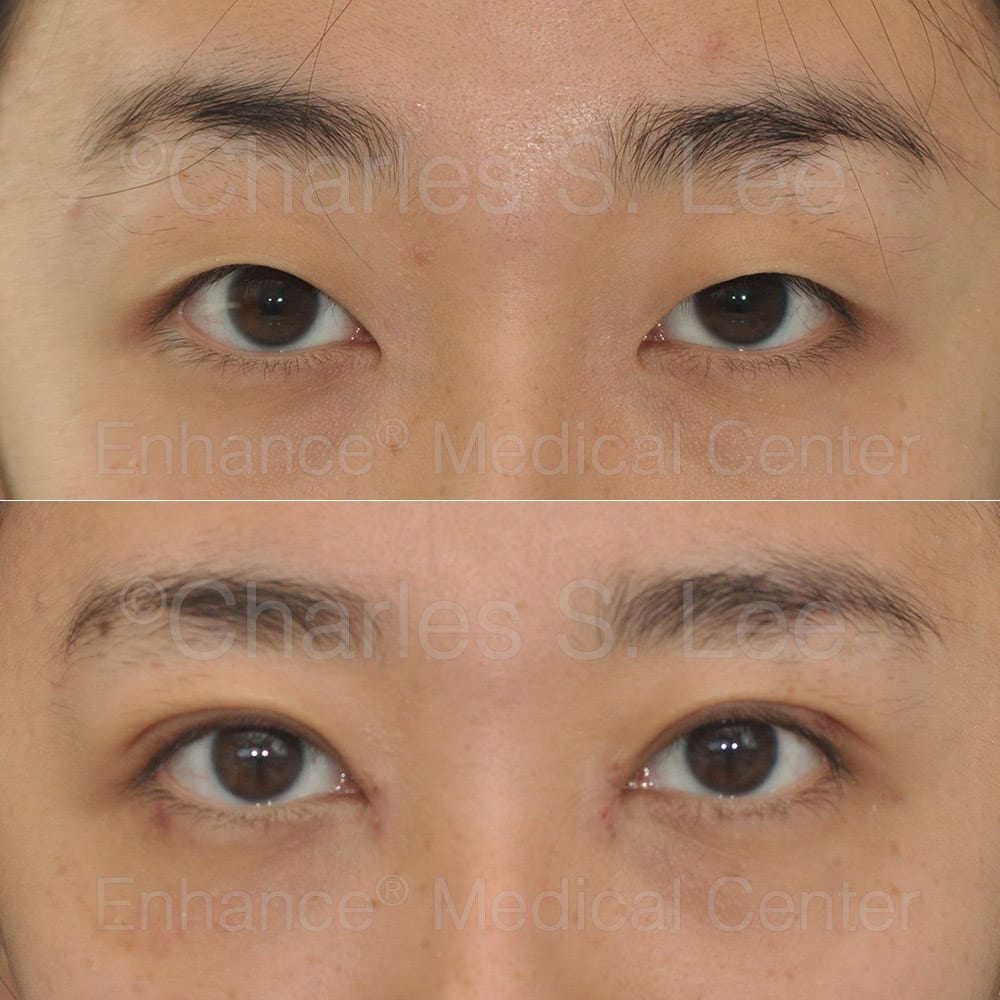 Asian Eyelid Surgery – DST suture method