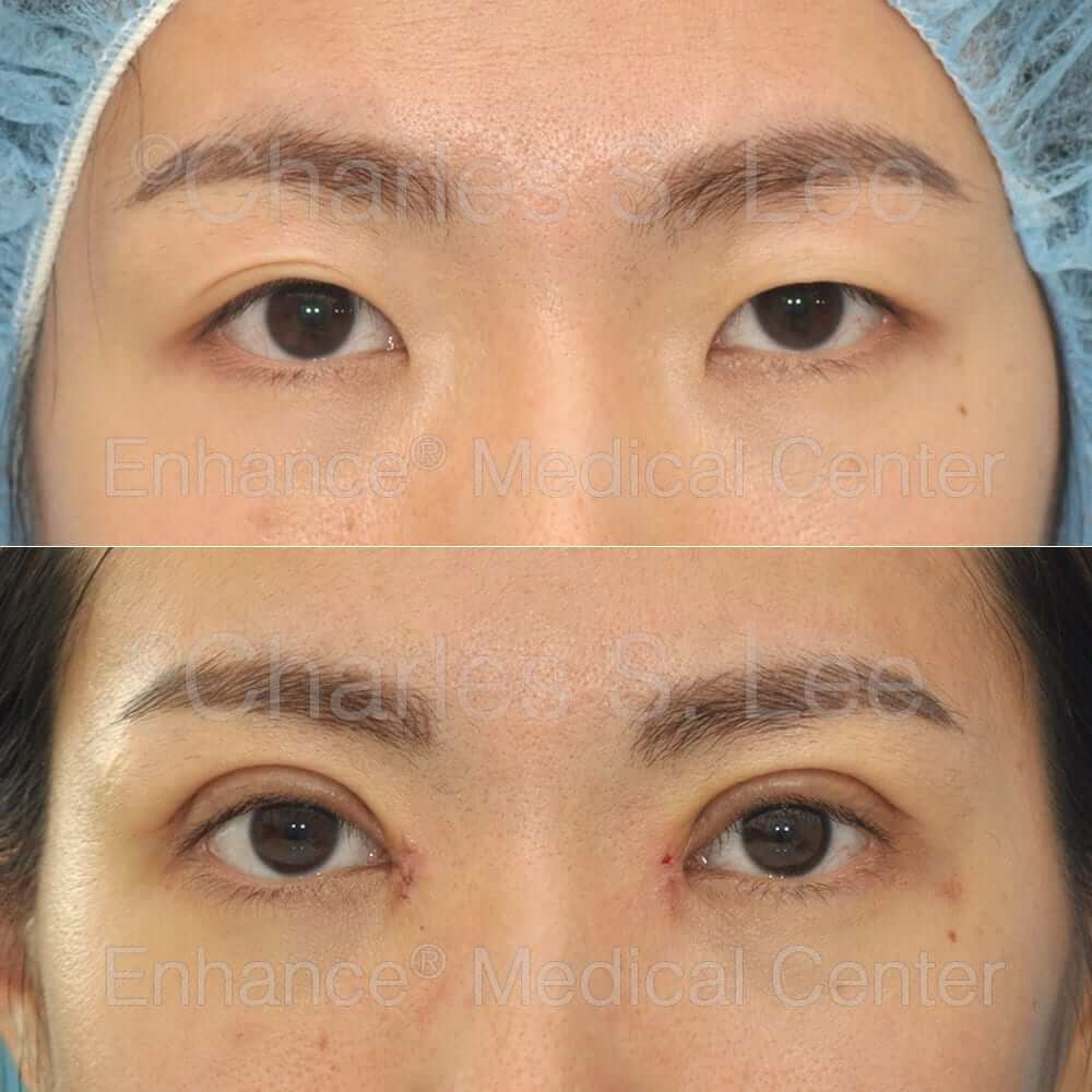 This is a recovery picture 7 days after eyelid and inner corner repair, with correction of internal muscle weakness on the left eyelid (ptosis)