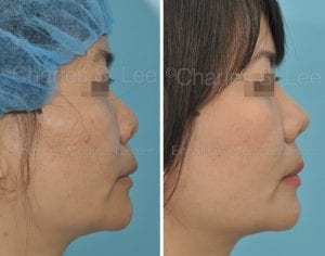 Rhinoplasty before and after side view