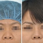 Rhinoplasty Before and after actual patient