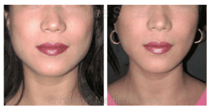 Define Your Face With Jaw Reduction