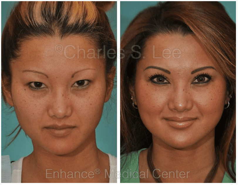 Asian Eyelid Surgery Photos 59