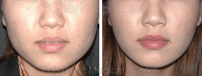 Non-Surgical Jaw Reduction Before and After Photo