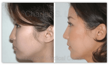 Asian Rhinoplasty Before and After Photo