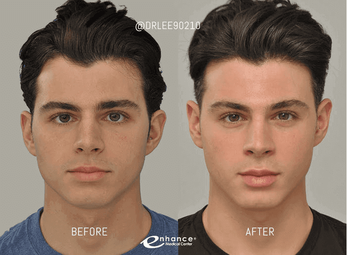 Look Your Best From Cheek To Cheek Enhance Medical Center
