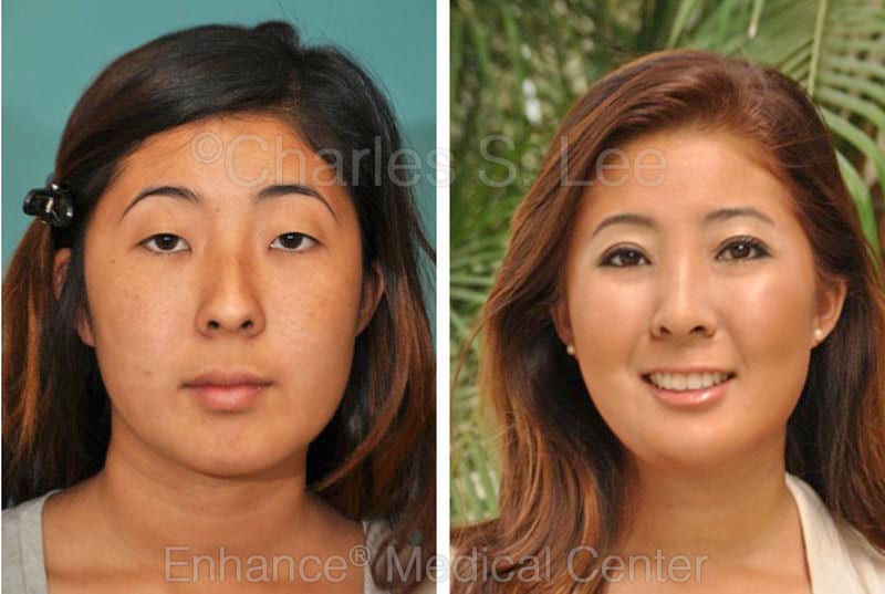 Female brow and face lift patient facing forward