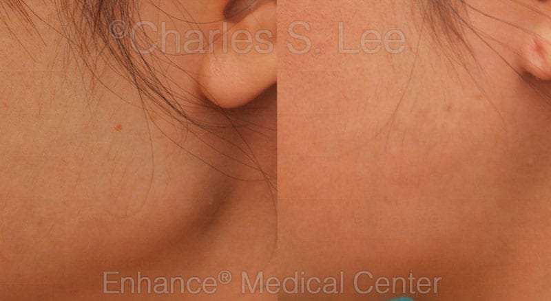 Jaw Reduction Side Patient 3