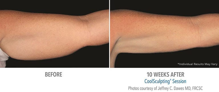 Eps Coolsculpting Arm Patient 2